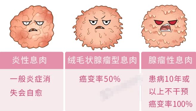肠道里长了息肉,上厕所时会有 4 个提示,别等到肠癌才后悔!(图1) 肠道里长了息肉,上厕所时会有 4 个提示,别等到肠癌才后悔!(图1)